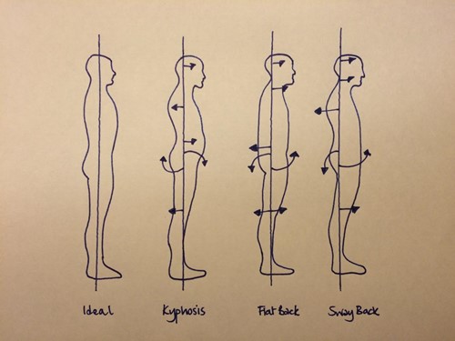 Illustration showing effects of poor head position