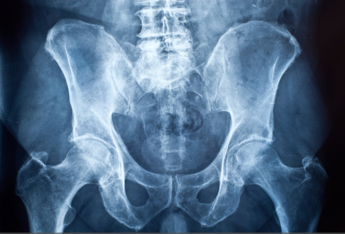 A pelvis xray